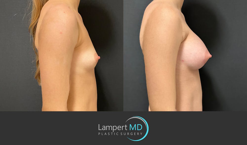 Breast Augmentation Before & After Gallery - Patient 149385048 - Image 5