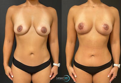 Mommy Makeover Before & After Gallery - Patient 148758156 - Image 1