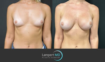 Breast Augmentation Before & After Gallery - Patient 143555920 - Image 1