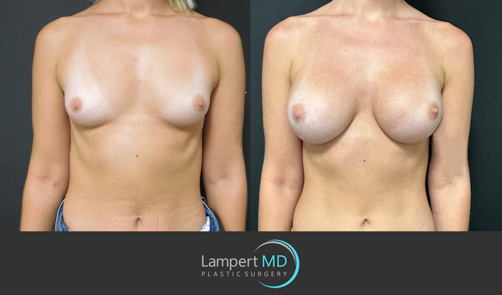 Breast Augmentation Before & After Gallery - Patient 143555920 - Image 1