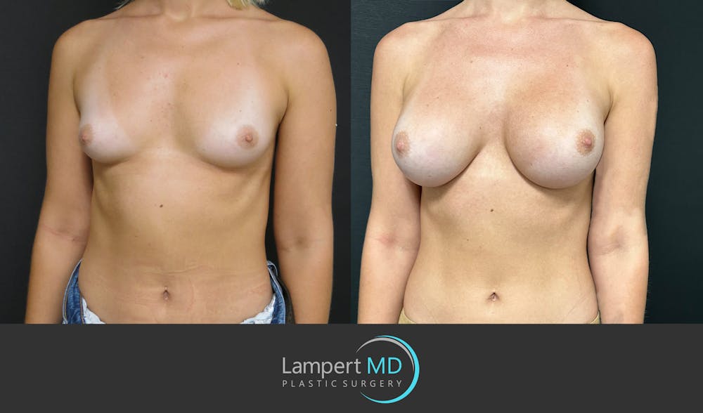 Breast Augmentation Before & After Gallery - Patient 143555920 - Image 2