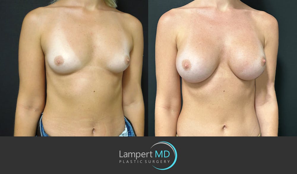 Breast Augmentation Before & After Gallery - Patient 143555920 - Image 3