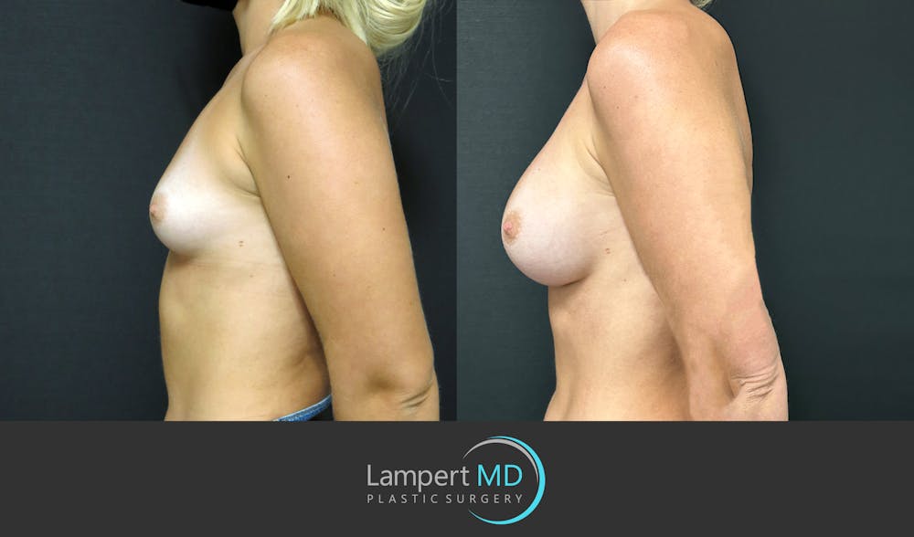 Breast Augmentation Before & After Gallery - Patient 143555920 - Image 4