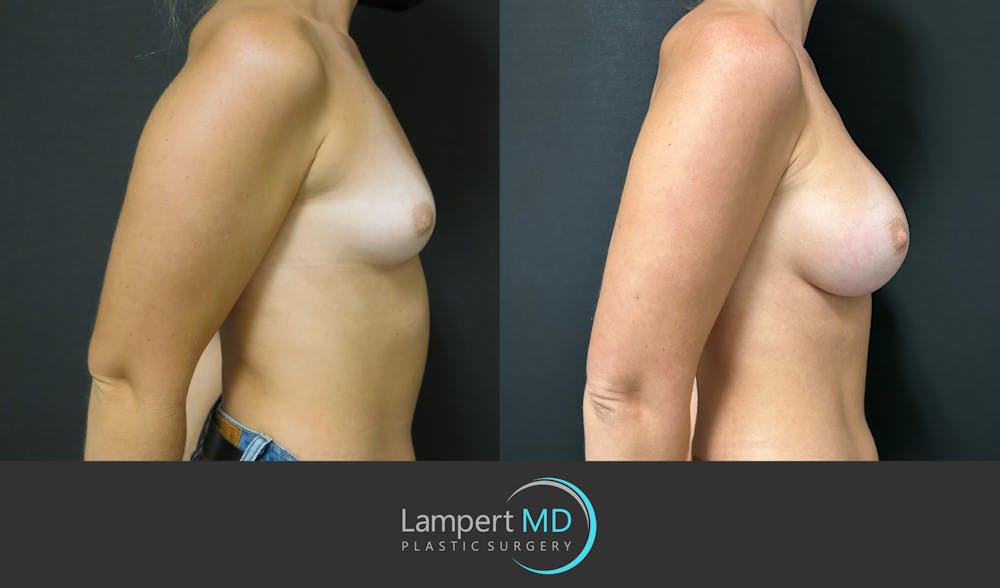 Breast Augmentation Before & After Gallery - Patient 143555920 - Image 5