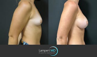 Breast Augmentation Before & After Gallery - Patient 143555920 - Image 5