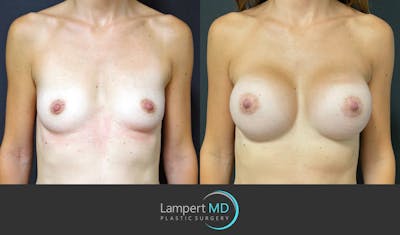 Breast Augmentation Before & After Gallery - Patient 143555840 - Image 1