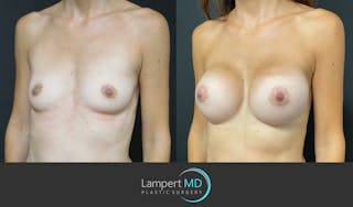 Breast Augmentation Before & After Gallery - Patient 143555840 - Image 2