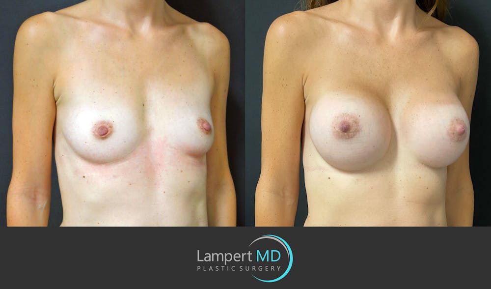 Breast Augmentation Before & After Gallery - Patient 143555840 - Image 3