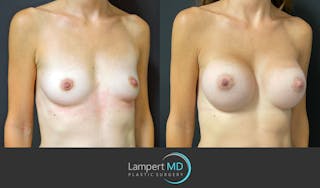 Breast Augmentation Before & After Gallery - Patient 143555840 - Image 3