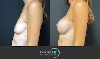 Breast Augmentation Before & After Gallery - Patient 143555840 - Image 4