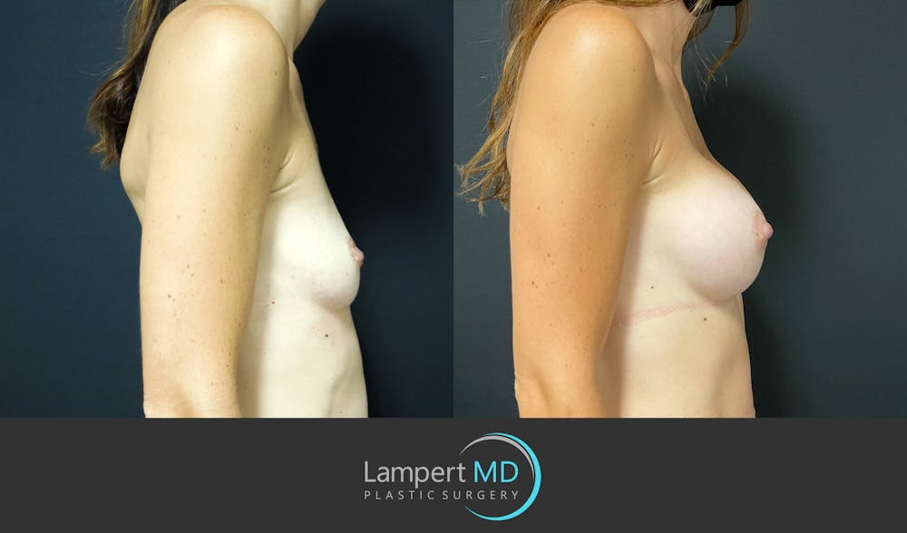 Breast Augmentation Before & After Gallery - Patient 143555840 - Image 5