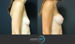 Breast Augmentation Before & After Gallery - Patient 143555840 - Image 5