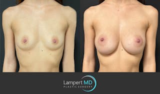 Breast Augmentation Before & After Gallery - Patient 143556105 - Image 1