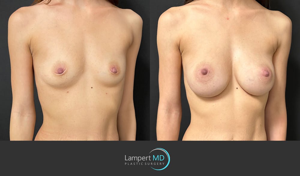 Breast Augmentation Before & After Gallery - Patient 143556105 - Image 2