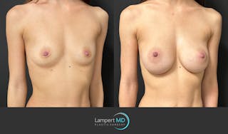 Breast Augmentation Before & After Gallery - Patient 143556105 - Image 2