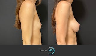 Breast Augmentation Before & After Gallery - Patient 143556105 - Image 3