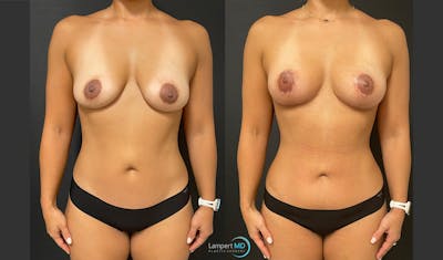 Tummy Tuck Before & After Gallery - Patient 157564477 - Image 1