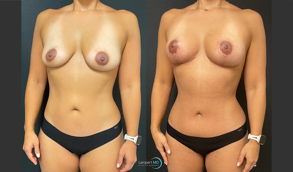 Tummy Tuck Before & After Gallery - Patient 157564477 - Image 2