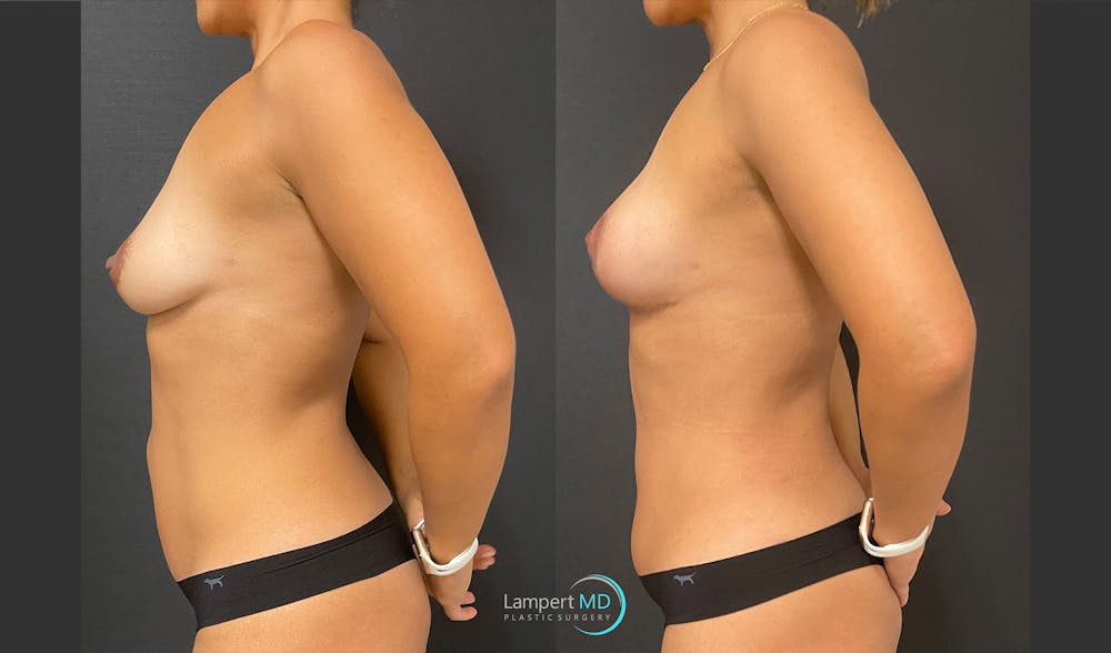 Breast Lift Before & After Gallery - Patient 151885218 - Image 3