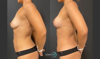 Tummy Tuck Before & After Gallery - Patient 157564477 - Image 3