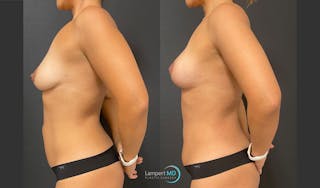 Breast Lift Before & After Gallery - Patient 151885218 - Image 3