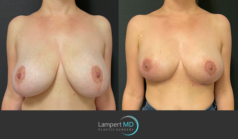 Breast Explant Before & After Gallery - Patient 164621105 - Image 1