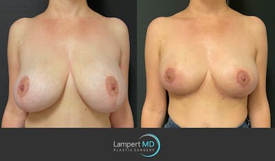 Breast Explant Before & After Gallery - Patient 164621105 - Image 1