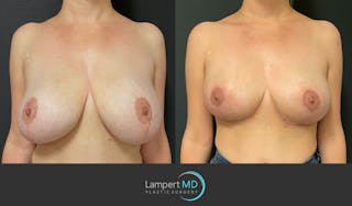 Breast Explant Before & After Gallery - Patient 164621105 - Image 1