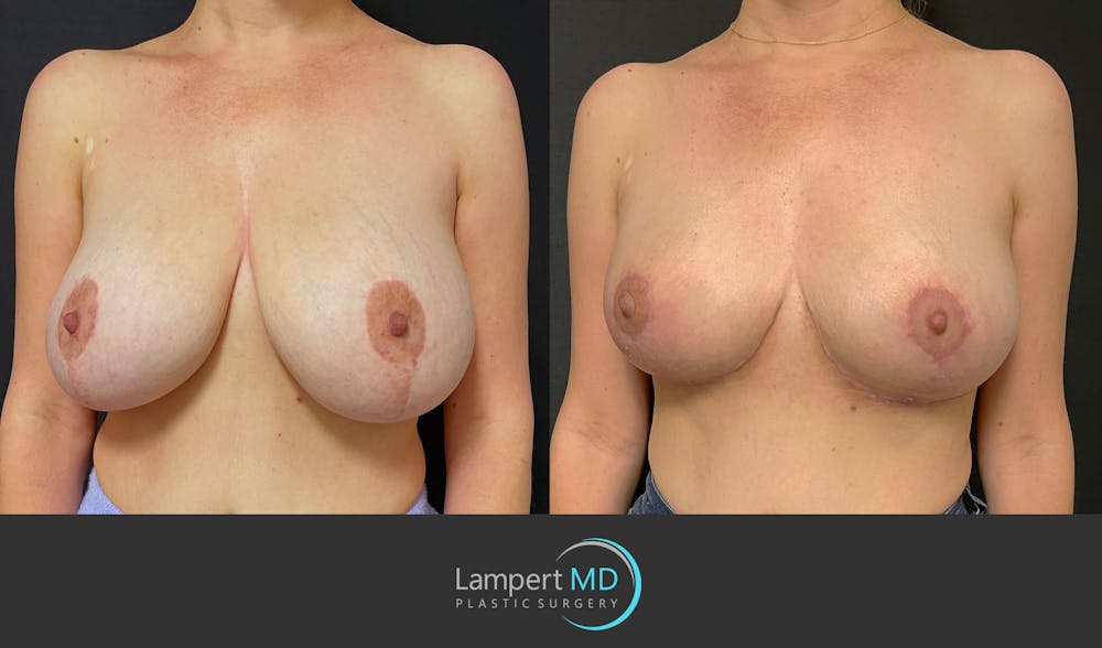 Breast Explant Before & After Gallery - Patient 164621105 - Image 2