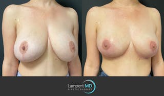 Breast Explant Before & After Gallery - Patient 164621105 - Image 3