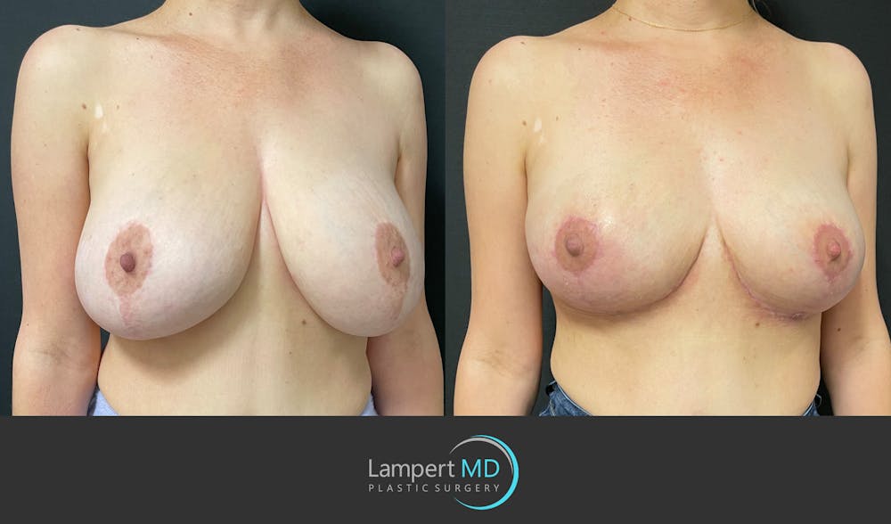 Breast Explant Before & After Gallery - Patient 164621105 - Image 3