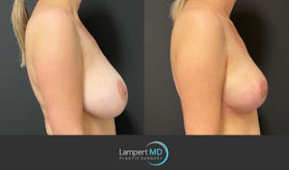 Breast Explant Before & After Gallery - Patient 164621105 - Image 4