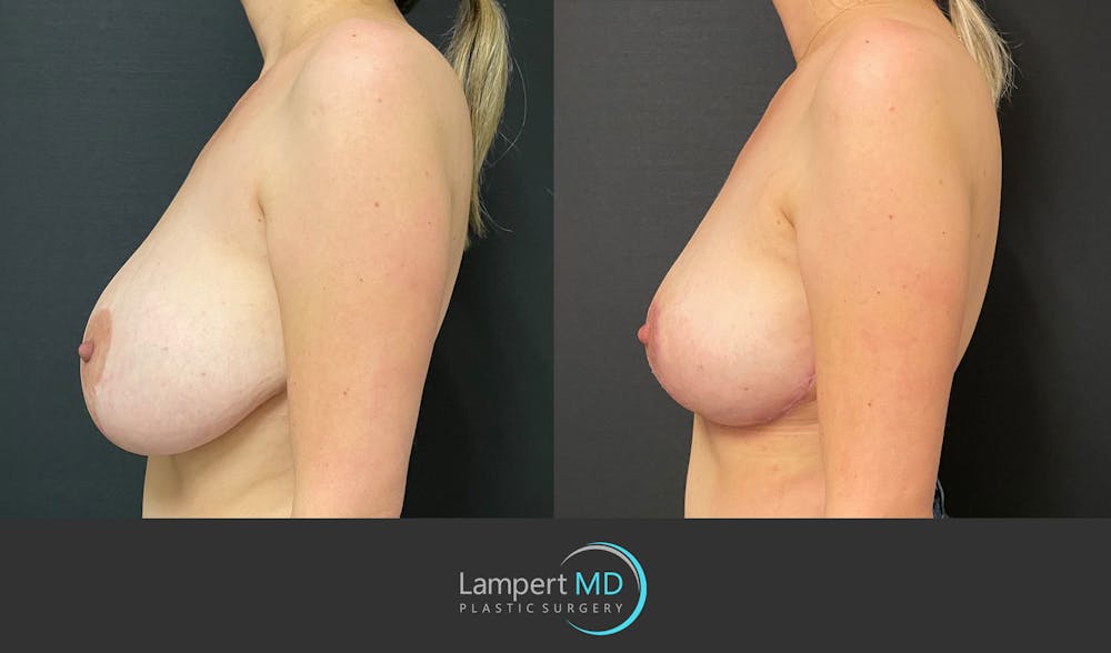 Breast Explant Before & After Gallery - Patient 164621105 - Image 5