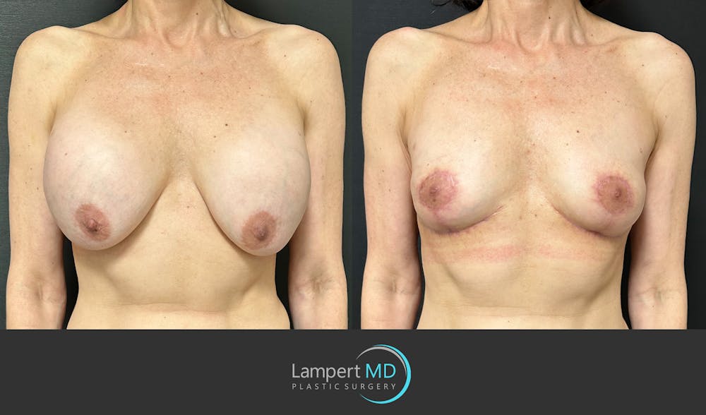 Breast Explant Before & After Gallery - Patient 151885261 - Image 1