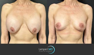 Breast Explant Before & After Gallery - Patient 151885261 - Image 1