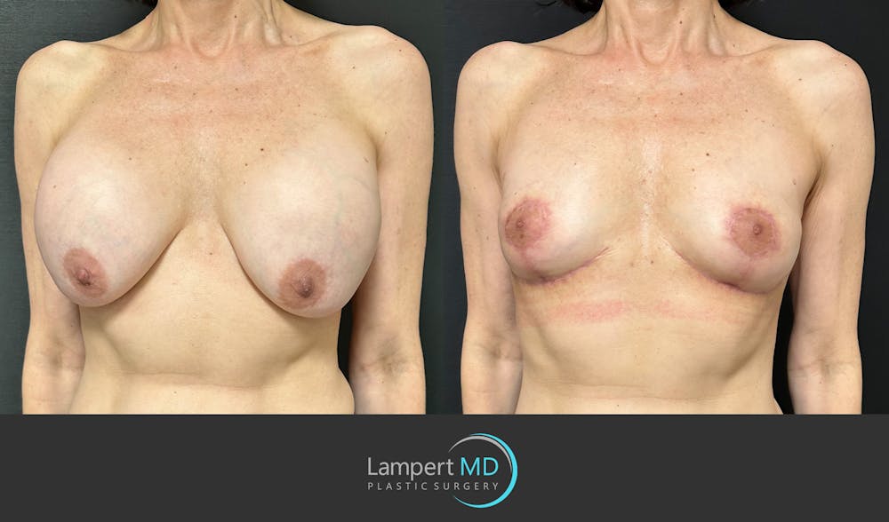 Breast Explant Before & After Gallery - Patient 151885261 - Image 2