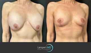 Breast Explant Before & After Gallery - Patient 151885261 - Image 3