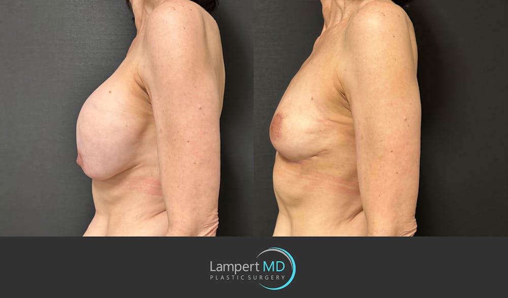 Breast Explant Before & After Gallery - Patient 151885261 - Image 4