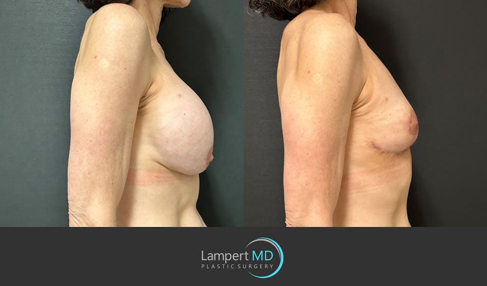 Breast Explant Before & After Gallery - Patient 151885261 - Image 5