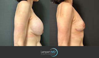 Breast Explant Before & After Gallery - Patient 151885261 - Image 5