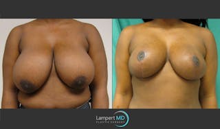 Breast Reduction Before & After Gallery - Patient 157558466 - Image 1