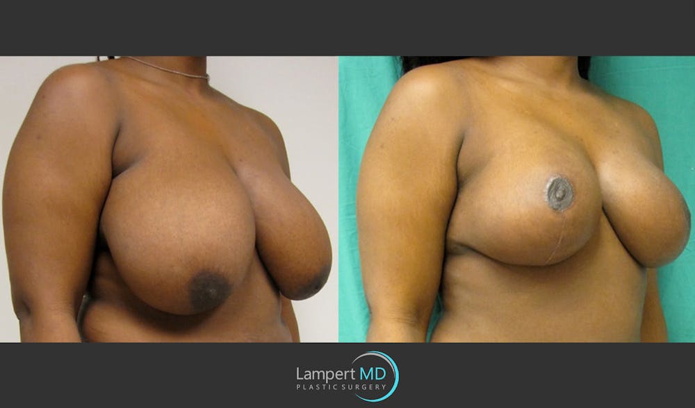 Breast Reduction Before & After Gallery - Patient 157558466 - Image 2