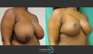 Breast Reduction Before & After Gallery - Patient 157558466 - Image 2