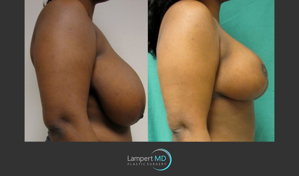 Breast Reduction Before & After Gallery - Patient 157558466 - Image 3