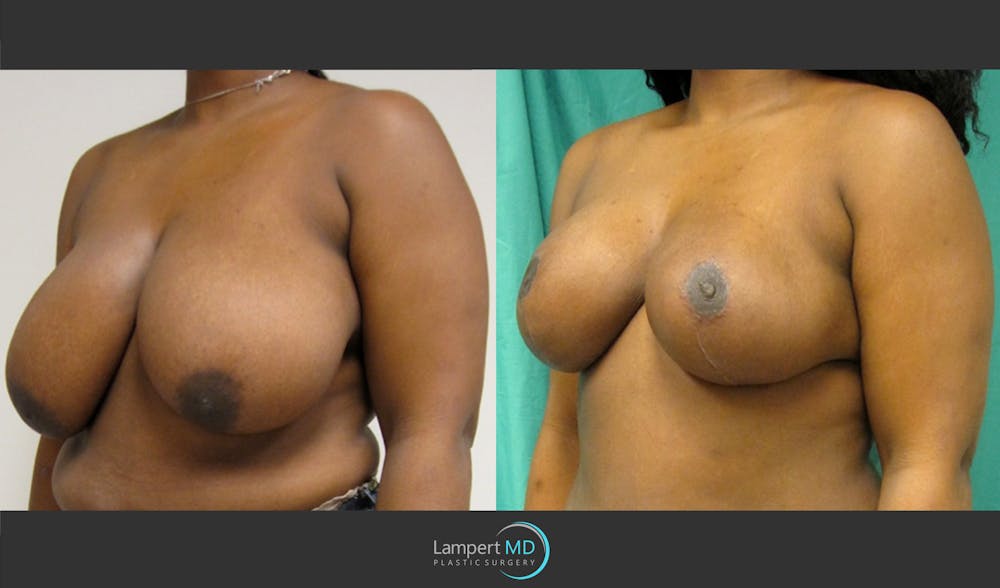 Breast Reduction Before & After Gallery - Patient 157558466 - Image 4