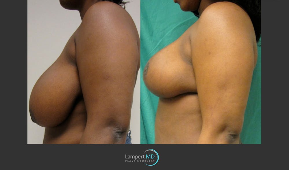 Breast Reduction Before & After Gallery - Patient 157558466 - Image 5