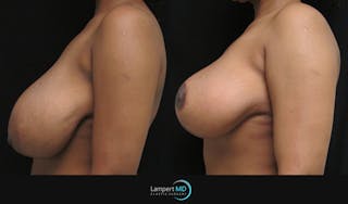 Breast Reduction Before & After Gallery - Patient 157558462 - Image 5