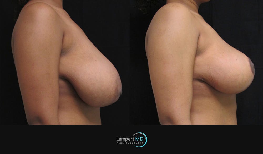 Breast Reduction Before & After Gallery - Patient 157558462 - Image 3