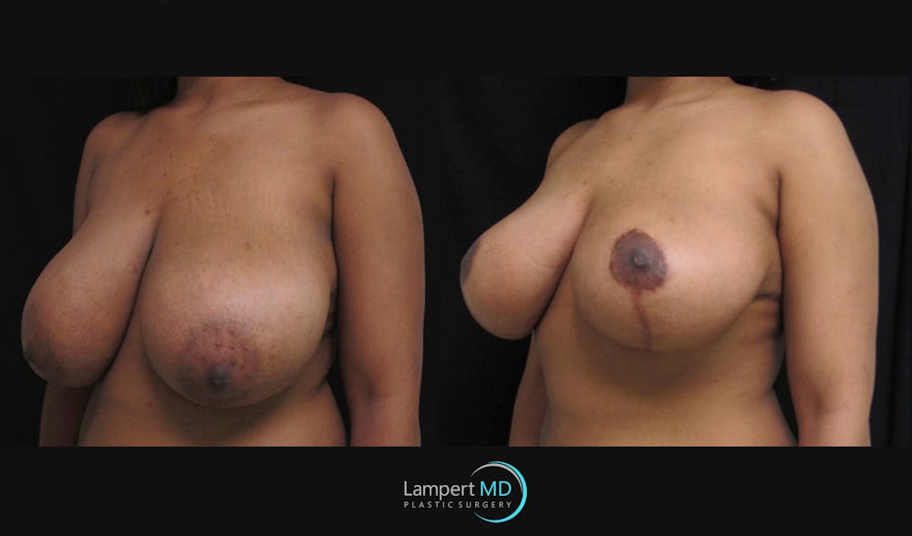 Breast Reduction Before & After Gallery - Patient 157558462 - Image 4