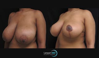 Breast Reduction Before & After Gallery - Patient 157558462 - Image 4
